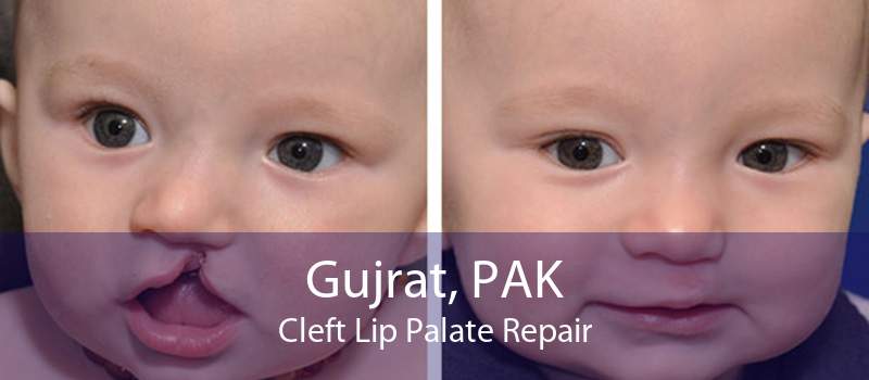 Gujrat, PAK Cleft Lip Palate Repair