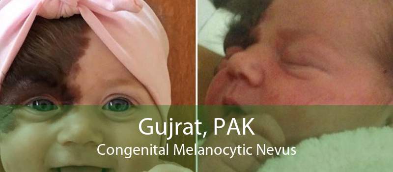 Gujrat, PAK Congenital Melanocytic Nevus