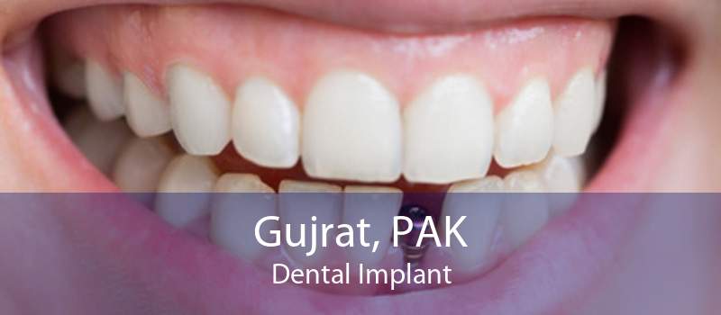 Gujrat, PAK Dental Implant