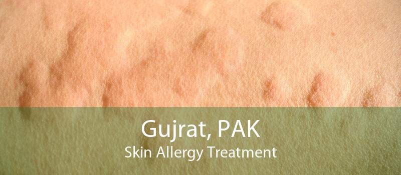 Gujrat, PAK Skin Allergy Treatment