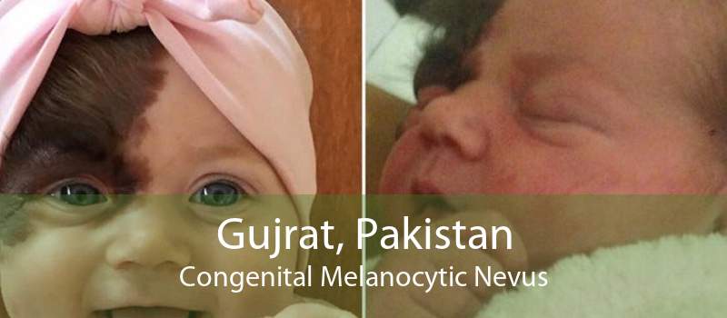 Gujrat, Pakistan Congenital Melanocytic Nevus