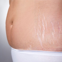 weight-gain-and-stretch-marks